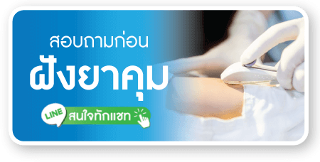 สอบถามก่อน ฝังยาคุม สอบถามก่อน ฝังยาคุม