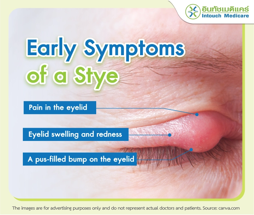 Early Symptoms of a Stye