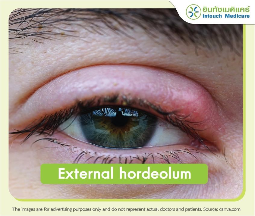 External Hordeolum