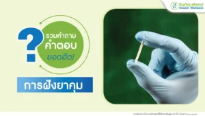 คำถามฝังยาคุมที่พบบ่อย พร้อมคำตอบฝังยาคุม