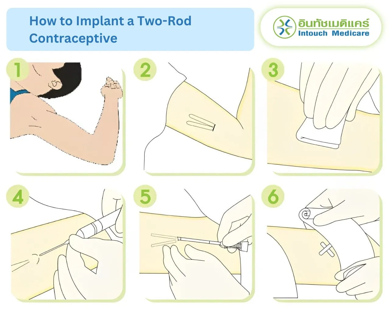 How to Implant a Two-Rod Contraceptive How to Implant a Two-Rod Contraceptive