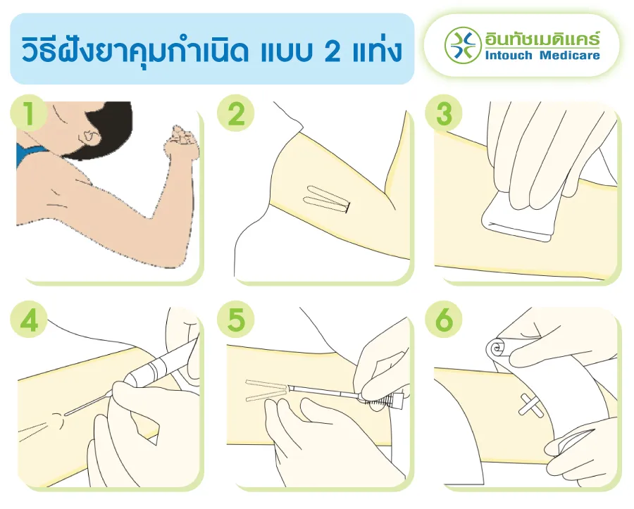 วิธีฝังยาคุมกำเนิด แบบ 2 แท่ง วิธีฝังยาคุมกำเนิด แบบ 2 แท่ง