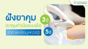 ฝังยาคุม