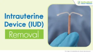 Intrauterine Device (IUD) Removal