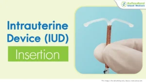 Intrauterine Device IUD insertion