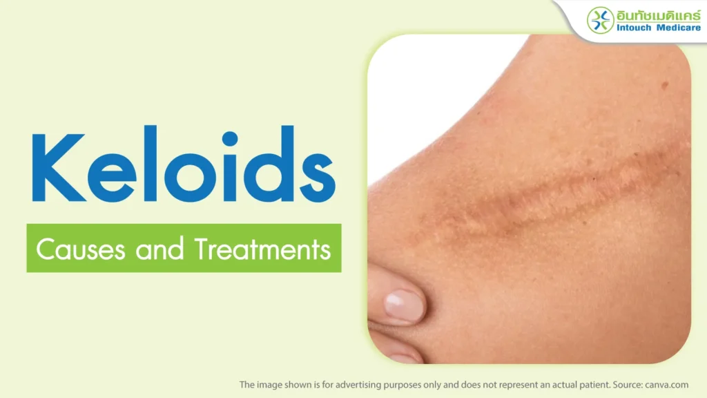 Keloids Causes and Treatments