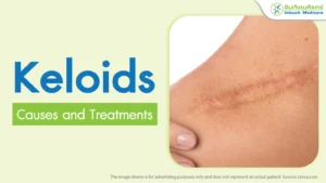 Keloids Causes and Treatments