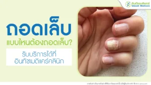 ถอดเล็บ ขั้นตอนและการดูแลอย่างถูกวิธี