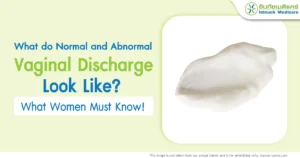 Normal and Abnormal Vaginal Discharge