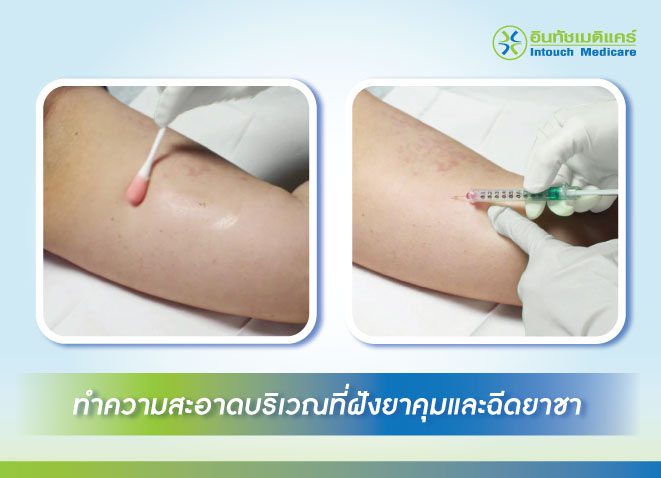 ทำความสะอาดบริเวณที่ฝังยาคุมและฉีดยาชา ทำความสะอาดบริเวณที่ฝังยาคุมและฉีดยาชา