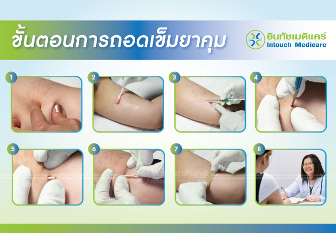 ขั้นตอนการถอดเข็มยาคุม ขั้นตอนการถอดเข็มยาคุม