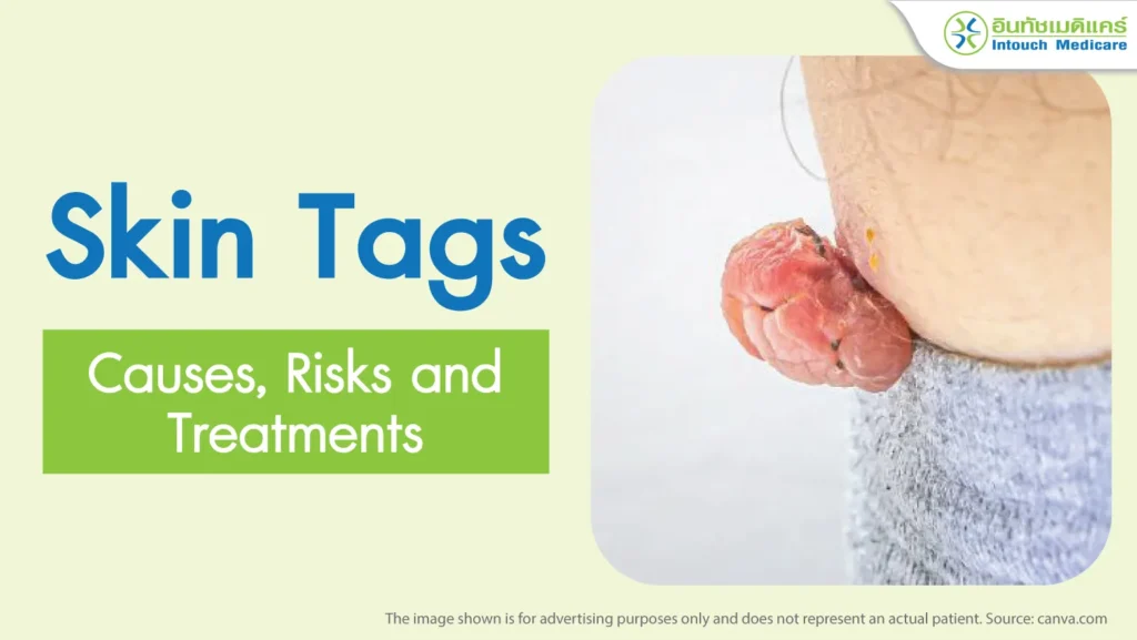 Skin Tags Causes Risks and Treatments