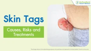 Skin Tags Causes Risks and Treatments