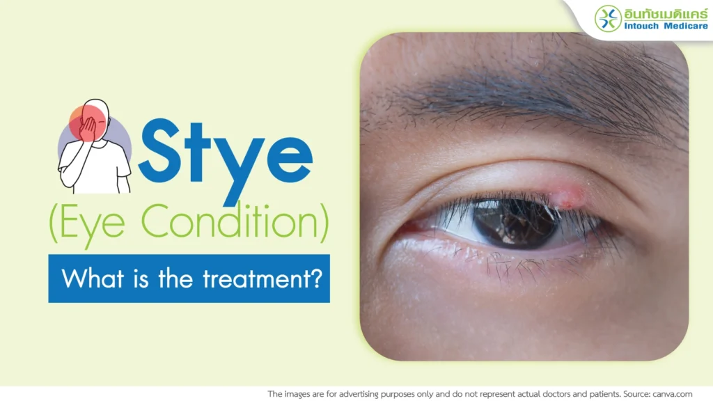 Stye (hordeolum)