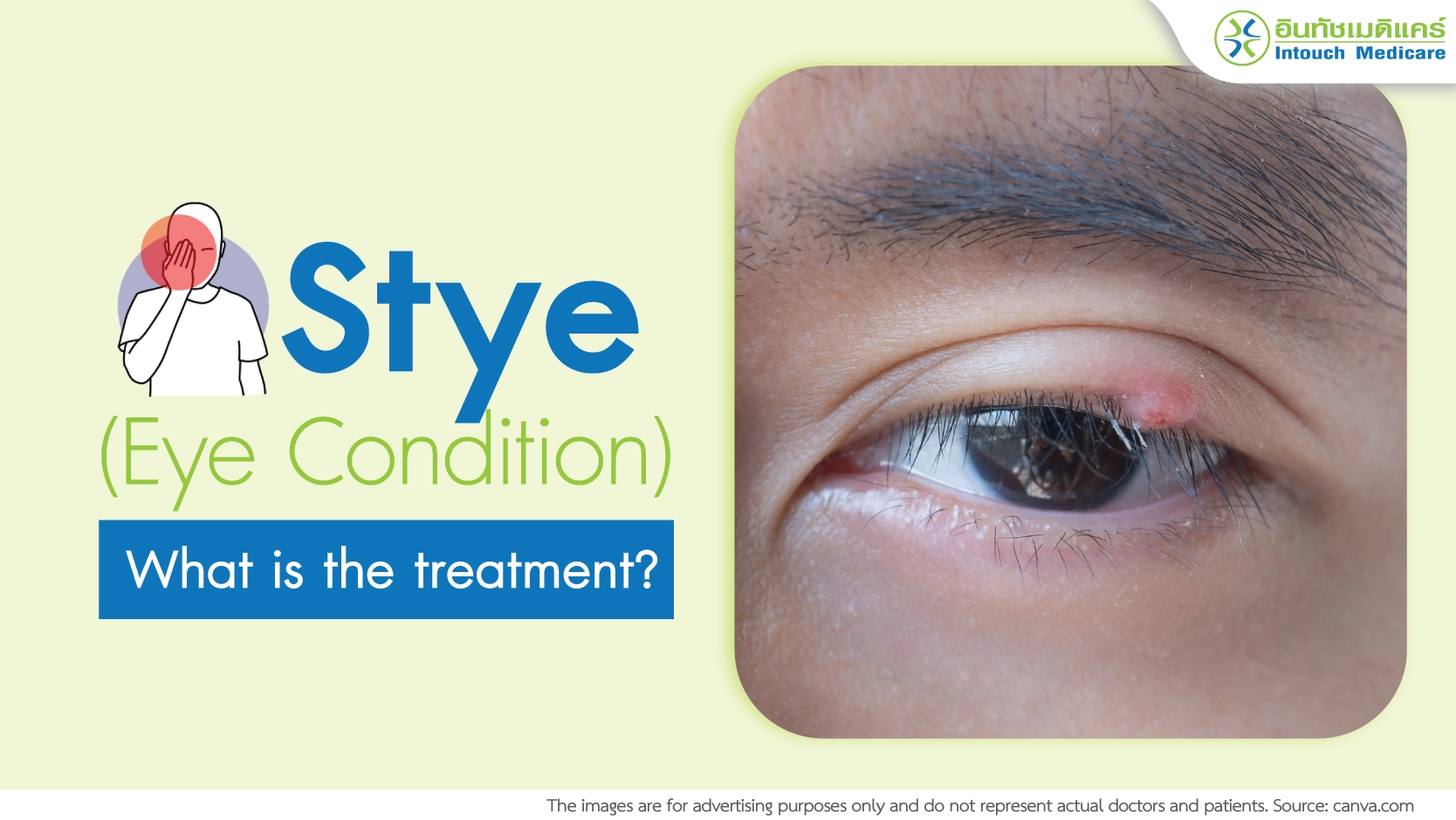 Stye [Eye Condition] – Treatable and Worry-Free!