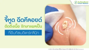 จี้หูด ฉีดคีลอยด์ ตัดติ่งเนื้อ