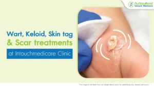 wart removal, keloid treatment injections, skin tag removal, and scar treatment services.
