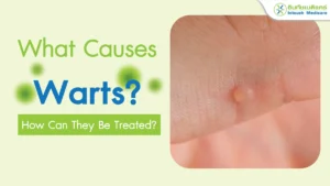 What Causes Warts? How Can They Be Treated