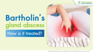 Bartholin’s gland inflammation or female genital abscess