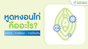 หูดหงอนไก่ คืออะไร