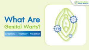 What Are Genital Warts?