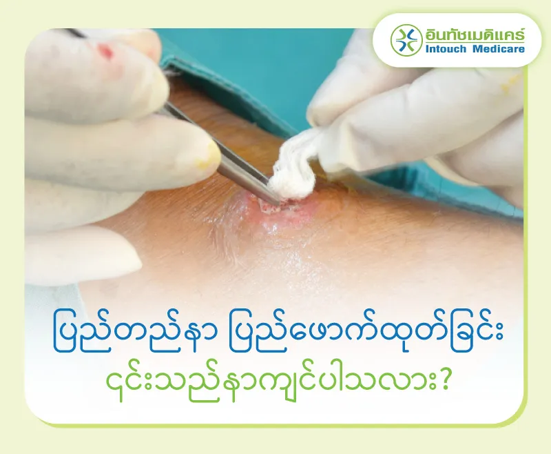ပြည်တည်နာ ပြည်ဖောက်ထုတ်ခြင်း ၎င်းသည်နာကျင်ပါသလား? ပြည်တည်နာ ပြည်ဖောက်ထုတ်ခြင်း ၎င်းသည်နာကျင်ပါသလား?