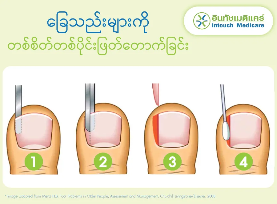partial nail excision partial nail excision