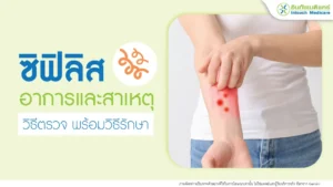 โรคซิฟิลิส
