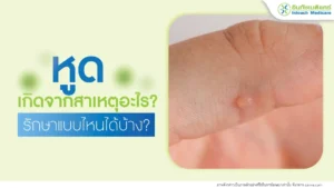 หูด เกิดจากสาเหตุอะไร?