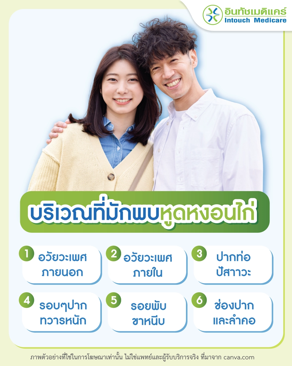 บริเวณที่มักพบหูดหงอนไก่