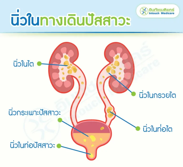นิ่วพบที่จุดไหนได้บ้าง