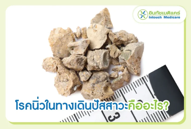 นิ่วทางเดินปัสาวะ คืออะไร