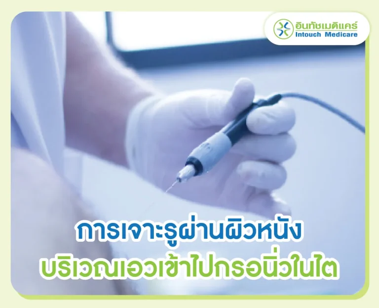 การเจาะรูผ่านผิวหนังบริเวณเอวเข้าไปกรอนิ่วในไต