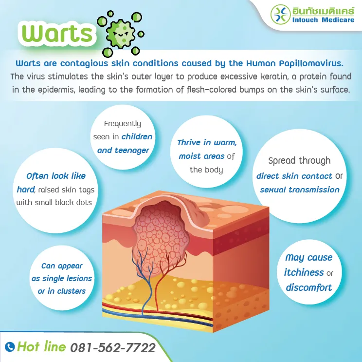 What Causes Warts How Can They Be Treated 