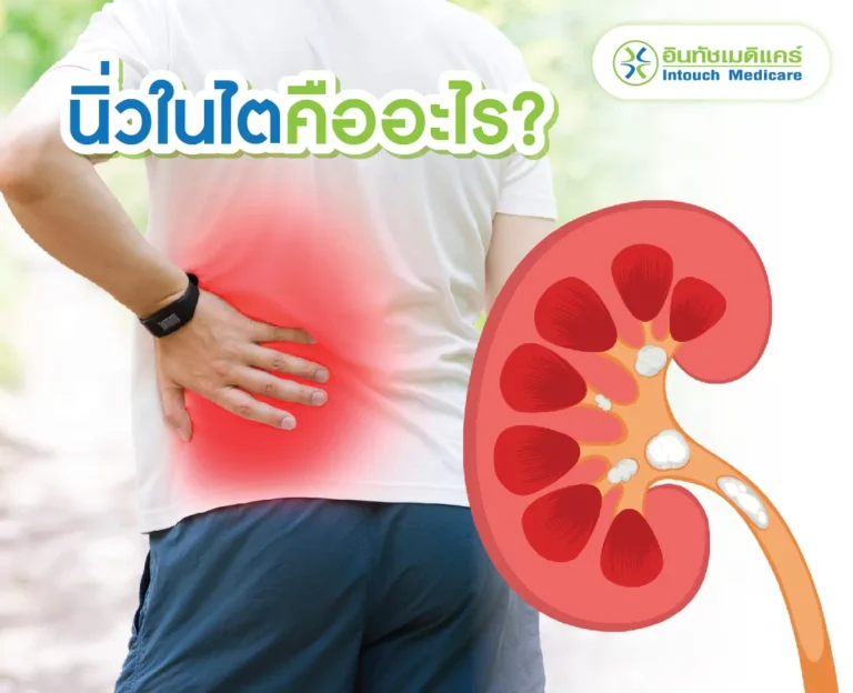 นิ่วในไต คิออะไร