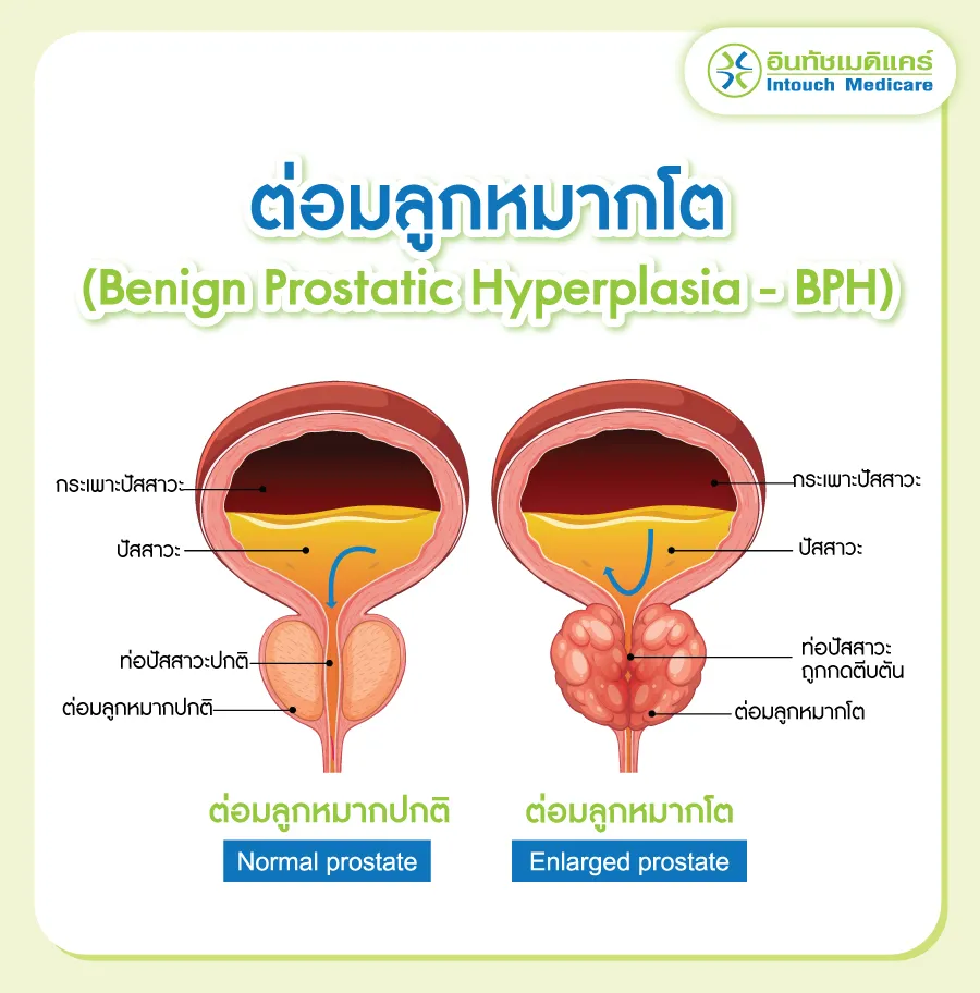 ต่อมลูกหมากโตคืออะไร