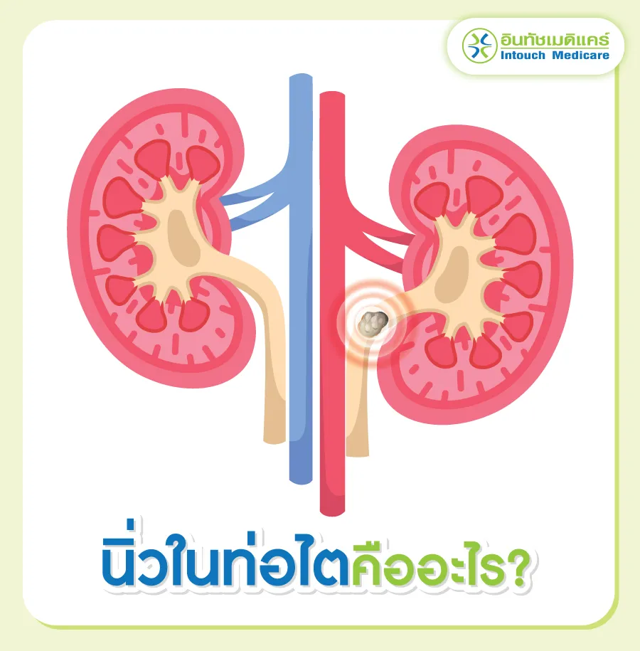 นิ่วในท่อไตคืออะไร 