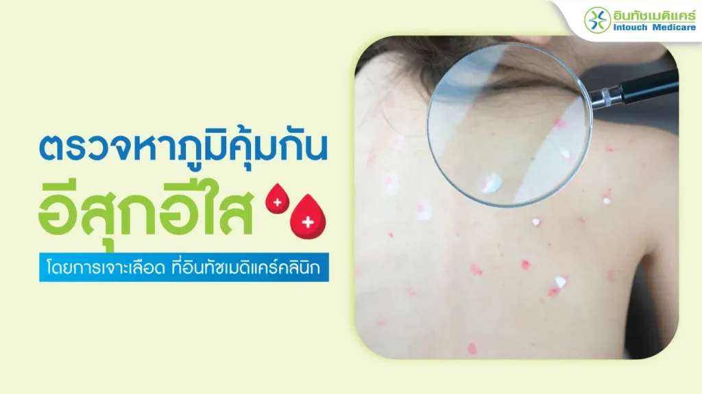 ตรวจภูมิคุ้มกันอีสุกอีใส
