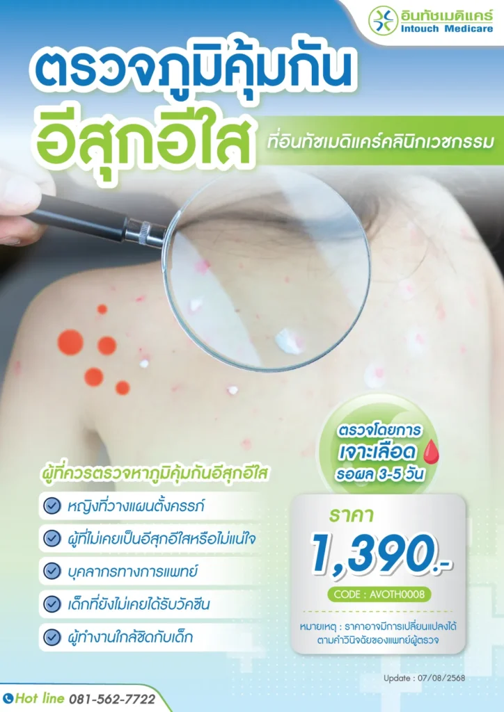 ราคาตรวจภูมิคุ้มกันโรคอีสุกอีใส
