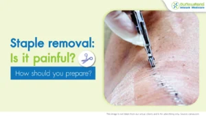 Staple removal