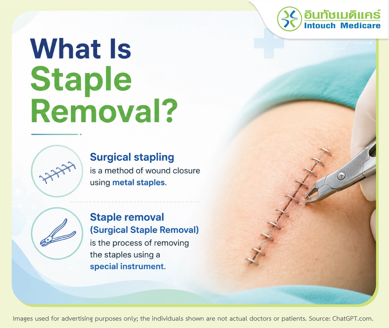 What Is Staple Removal