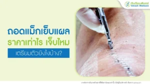 ถอดแม็กเย็บแผล หรือ เอาเแม็กเย็บแผลออก ที่คลินิกราคาเท่าไร