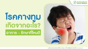 โรคคางทูม