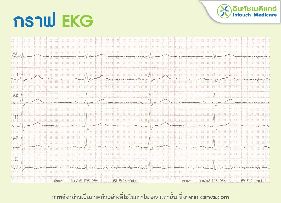 กราฟคลื่นไฟฟ้าหัวใจ