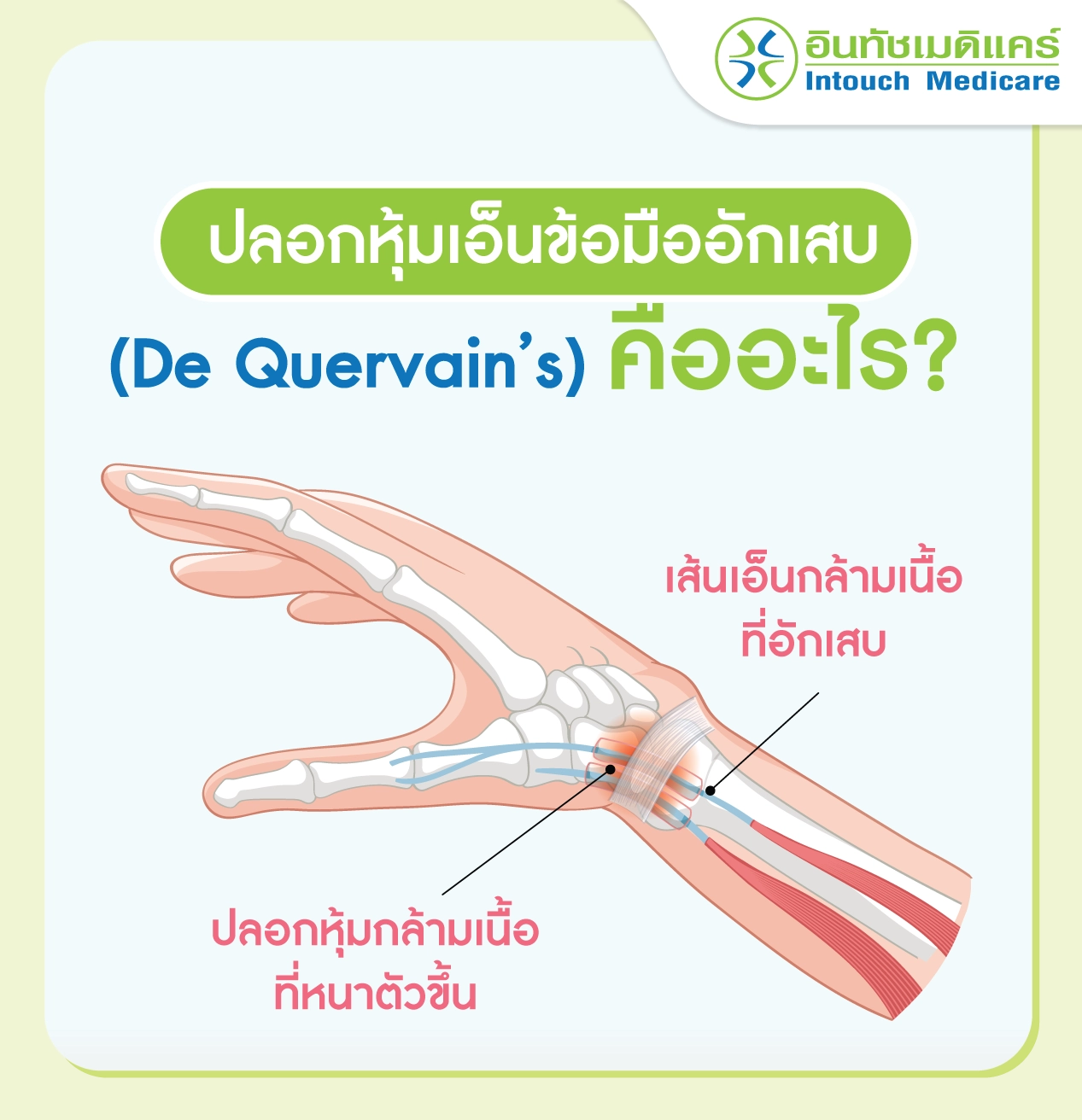 โรคปลอกหุ้มเอ็นข้อมืออักเสบคืออะไร