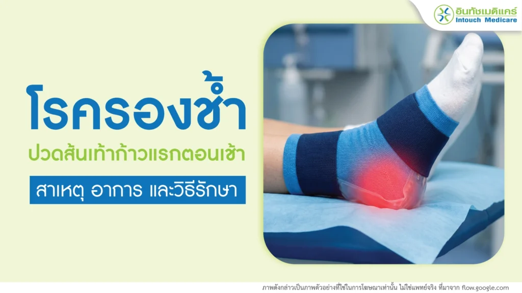 โรครองช้ำ Plantar fasciitis