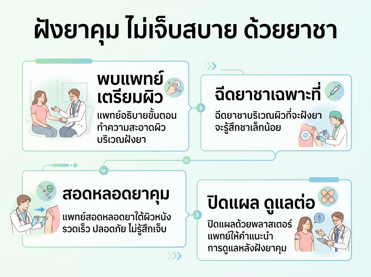 ขั้นตอนการฝังยาคุมที่ไม่เจ็บด้วยยาชา