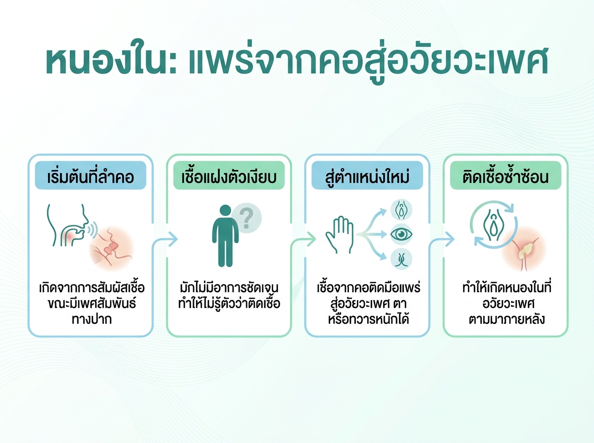 ภาพแสดงการแพร่กระจายของเชื้อหนองในจากคอไปยังอวัยวะเพศ