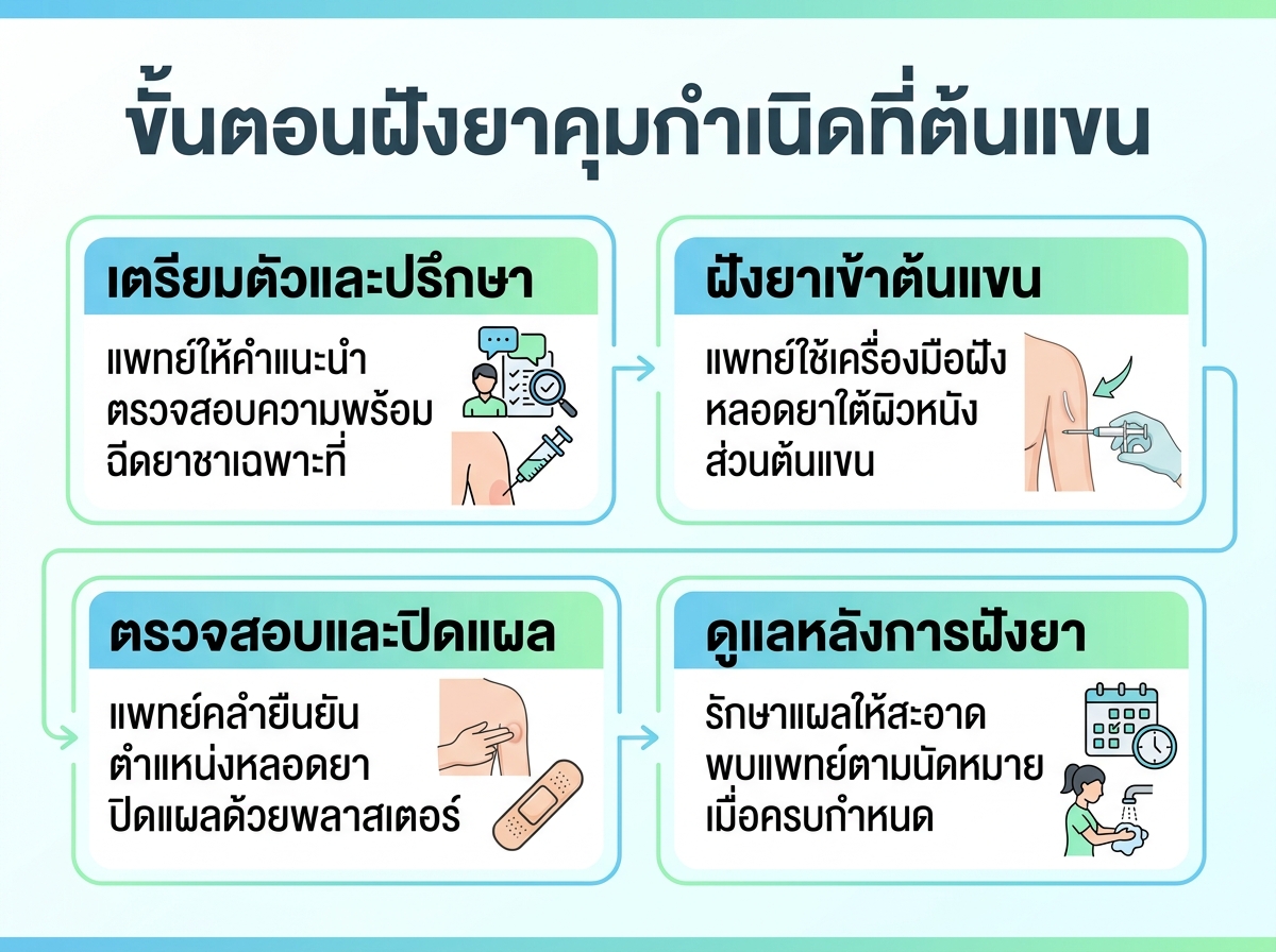 ขั้นตอนการฝังยาคุมกำเนิดบริเวณต้นแขน
