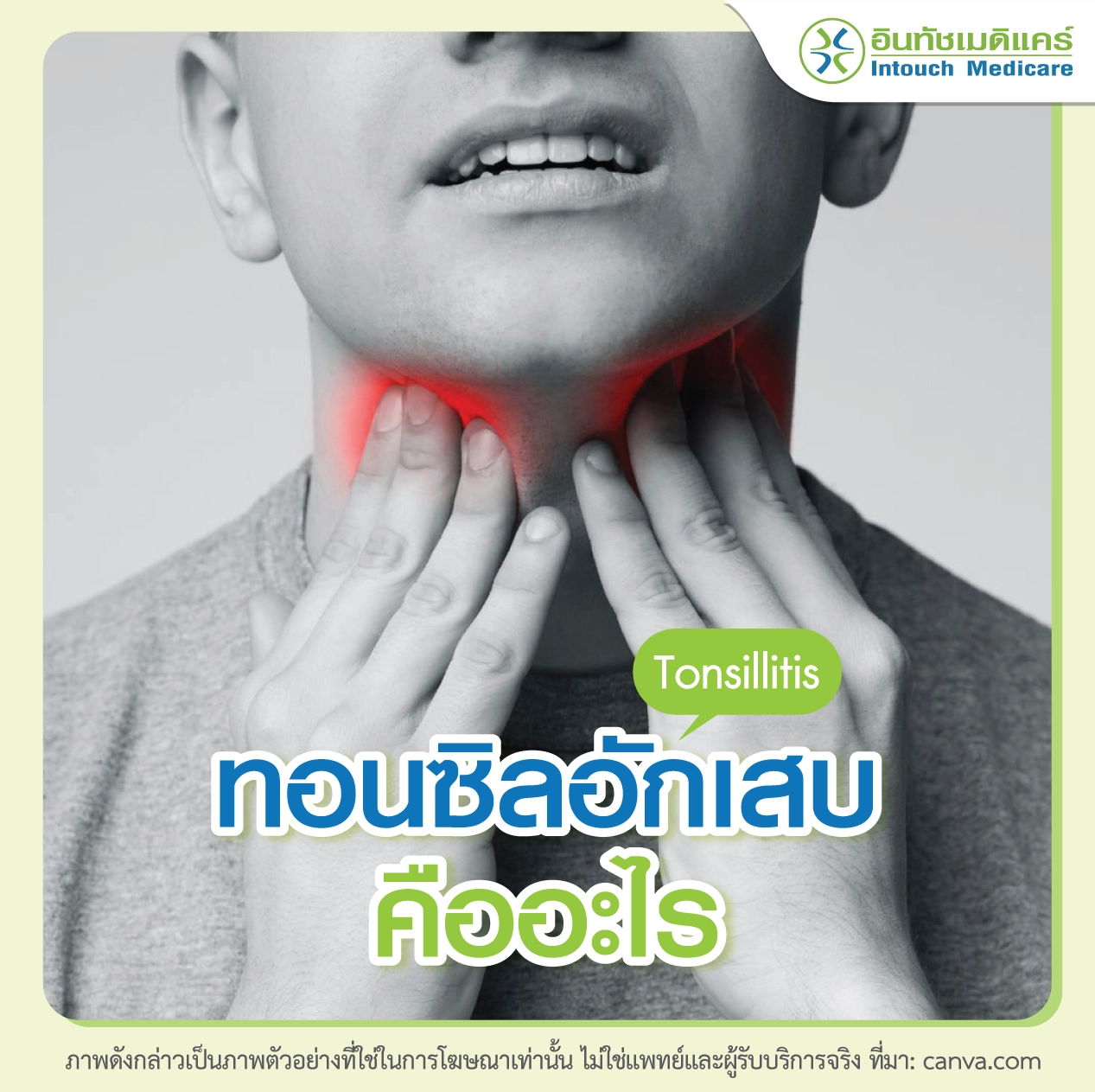 ทอนซิลอักเสบ (Tonsillitis) คืออะไร